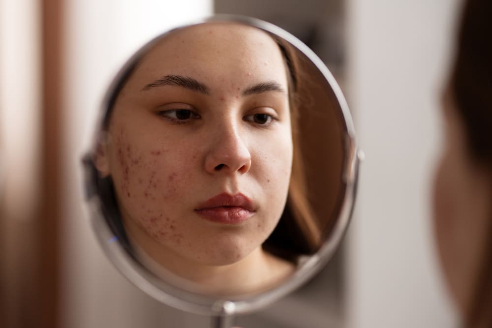 girl with acne and rosacea